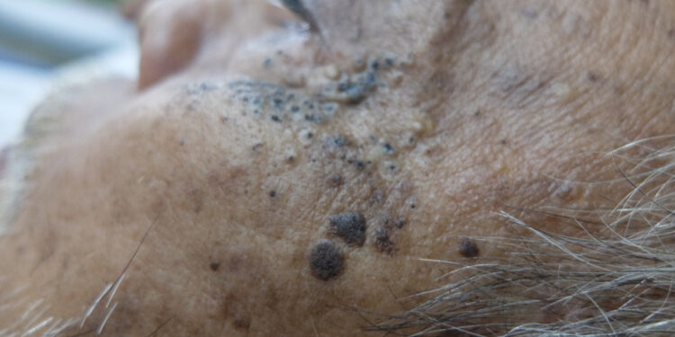 Plaukuotojų ląstelių leukemija: simptomai, priežastys ir gydymas