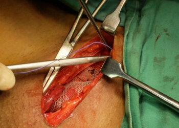 Šlaunies išvarža: kas tai, simptomai, vieta, gydymas