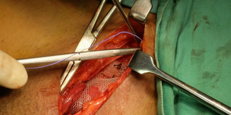 Šlaunies išvarža: kas tai, simptomai, vieta, gydymas