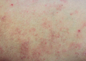 Kaposi sarkoma: simptomai, priežastys ir gydymas