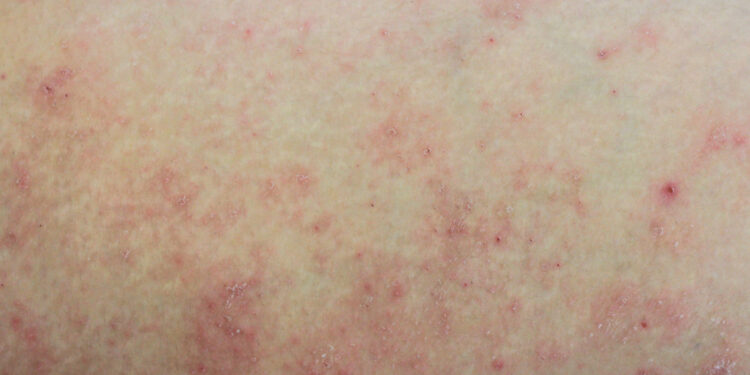 Kaposi sarkoma: simptomai, priežastys ir gydymas