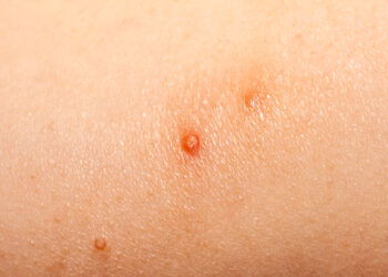 Histoplazmozė: priežastys, simptomai, diagnostika ir gydymas