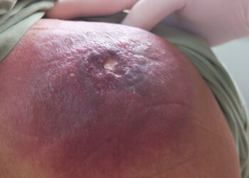 Marginalinės zonos limfoma (MZL): simptomai ir gydymas