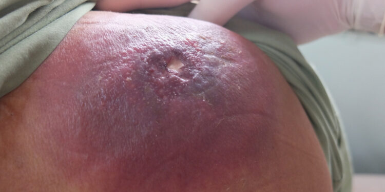 Marginalinės zonos limfoma (MZL): simptomai ir gydymas