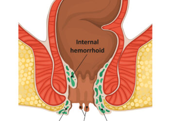 Hemorojus nėštumo metu: priežastys, profilaktika ir gydymas