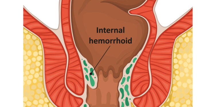 Hemorojus nėštumo metu: priežastys, profilaktika ir gydymas