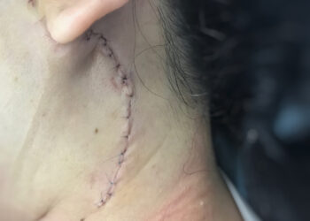 Prieausinės liaukos navikai: simptomai, priežastys ir gydymas