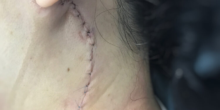 Prieausinės liaukos navikai: simptomai, priežastys ir gydymas