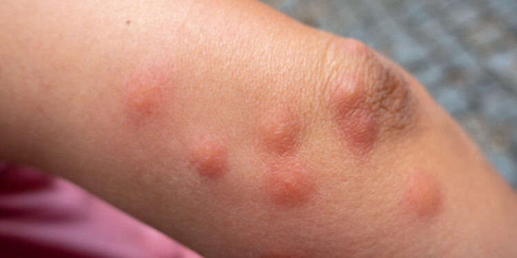 Blusų įkandimai: kaip atpažinti, simptomai ir gydymas