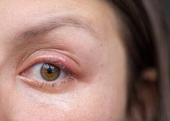 Panuveitas: kas tai, priežastys, simptomai ir gydymas