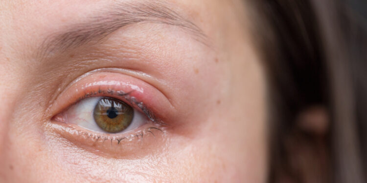 Panuveitas: kas tai, priežastys, simptomai ir gydymas