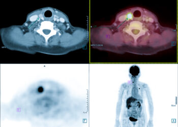 Požandikauliniai limfmazgiai