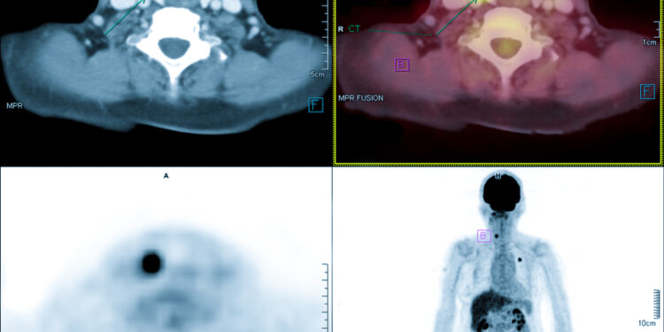 Požandikauliniai limfmazgiai