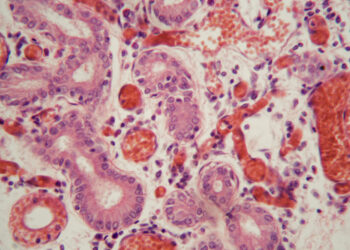 NUT karcinoma: priežastys, simptomai ir prognozė