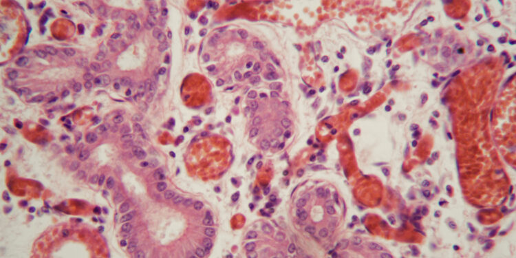 NUT karcinoma: priežastys, simptomai ir prognozė