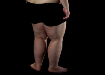 Lipedema