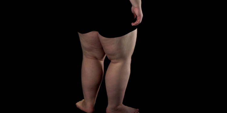 Lipedema: Priežastys, simptomai ir gydymas