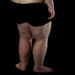 Lipedema: Priežastys, simptomai ir gydymas