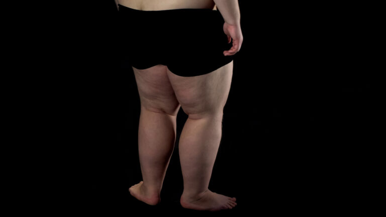 Lipedema