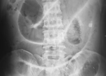 Meckelio divertikulas: simptomai, diagnostika ir gydymas