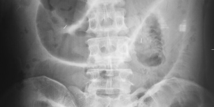 Meckelio divertikulas: simptomai, diagnostika ir gydymas