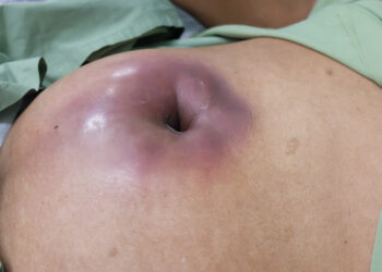 Priekinė gilioji smilkinio arterija