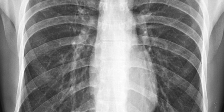 Mekonijaus aspiracijos sindromas: priežastys, gydymas ir sveikimas
