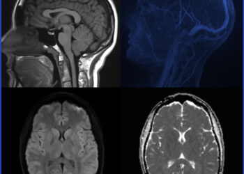 Pelizejaus-Mercbacherio liga (PML): simptomai ir gydymas