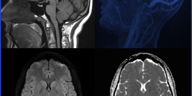 Pelizejaus-Mercbacherio liga (PML): simptomai ir gydymas
