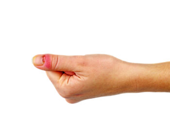 Piršto pūlinys: priežastys, simptomai ir gydymas