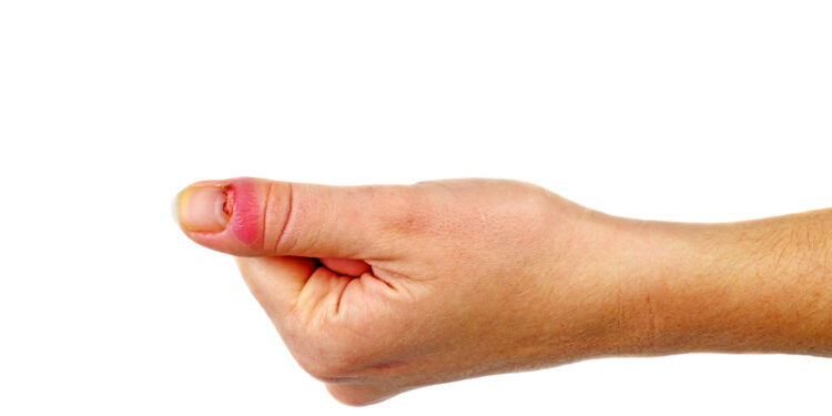 Piršto pūlinys: priežastys, simptomai ir gydymas