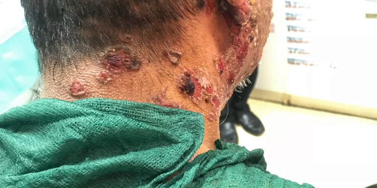 Pemfigus vulgaris: simptomai, priežastys ir gydymas