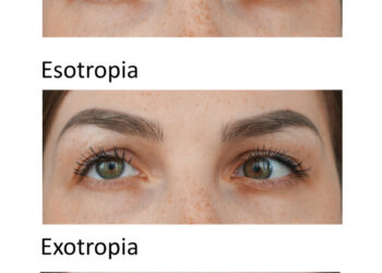 Esotropija: tipai, simptomai, priežastys ir gydymas