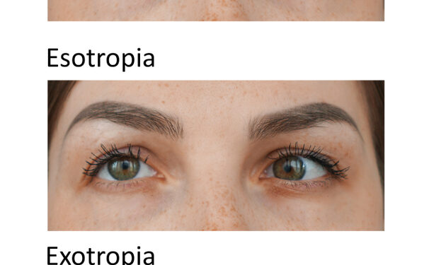 Esotropija: tipai, simptomai, priežastys ir gydymas