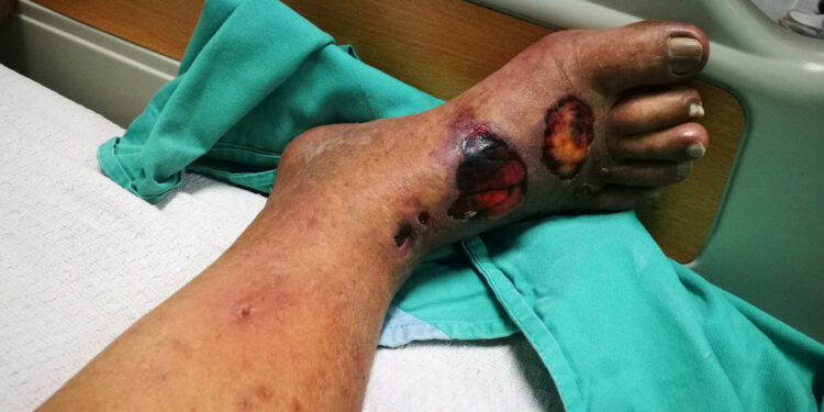 Osteomielitas (kaulų infekcija): priežastys, simptomai ir gydymas