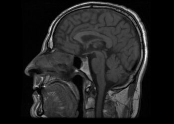 Pagumburio hamartoma: simptomai, gydymas ir prognozė