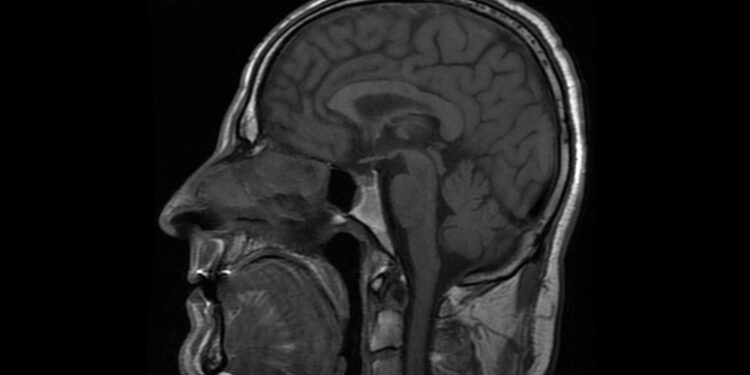 Pagumburio hamartoma: simptomai, gydymas ir prognozė