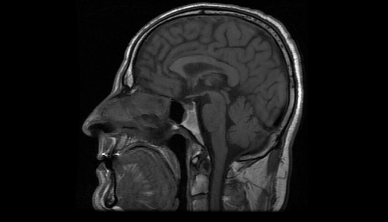 Pagumburio hamartoma: simptomai, gydymas ir prognozė