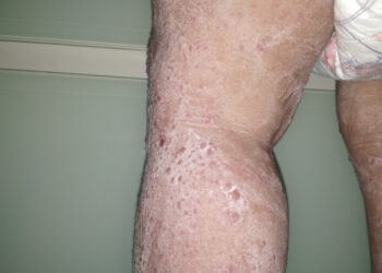 Periferinė T ląstelių limfoma: simptomai, priežastys ir prognozė