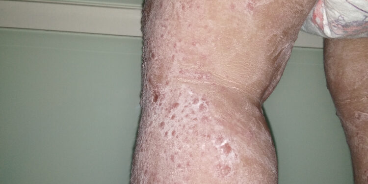 Periferinė T ląstelių limfoma: simptomai, priežastys ir prognozė