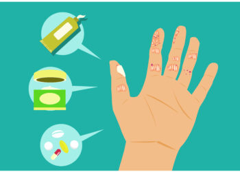 Ar tai žvynelinė, ar nuodingoji gebenė? Kaip atpažinti ir gydyti