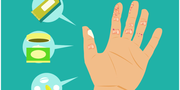 Ar tai žvynelinė, ar nuodingoji gebenė? Kaip atpažinti ir gydyti