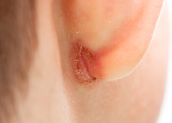 Užkrėsta ausies auskarų vieta: simptomai, gydymas ir profilaktika