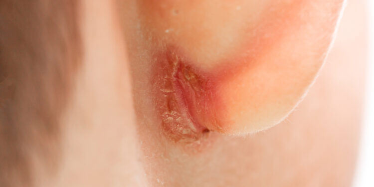 Užkrėsta ausies auskarų vieta: simptomai, gydymas ir profilaktika