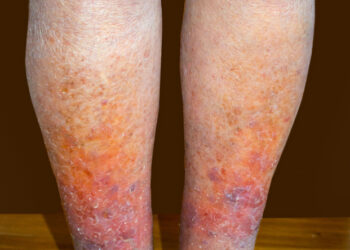 Klippelio–Trenaunay sindromas (KTS): simptomai ir gydymas