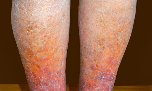 Klippelio–Trenaunay sindromas (KTS): simptomai ir gydymas