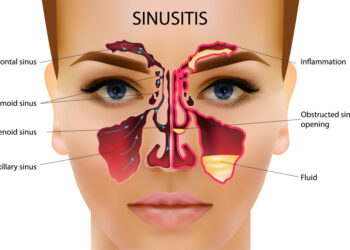 Nosies pertvaros skylė: simptomai, priežastys ir gydymas