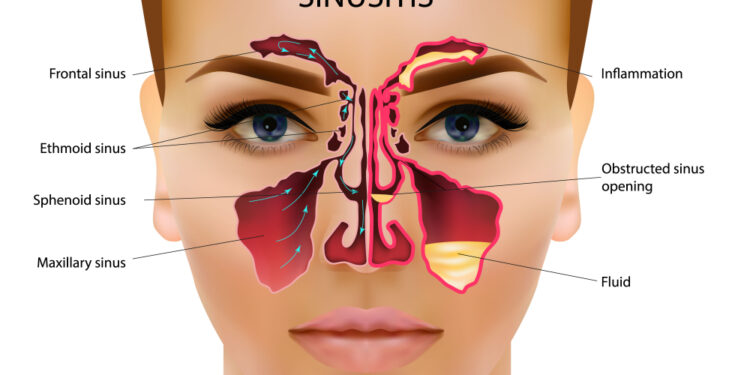 Nosies pertvaros skylė: simptomai, priežastys ir gydymas