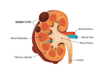 Medulinė kempinė inkstuose: priežastys, simptomai ir gydymas