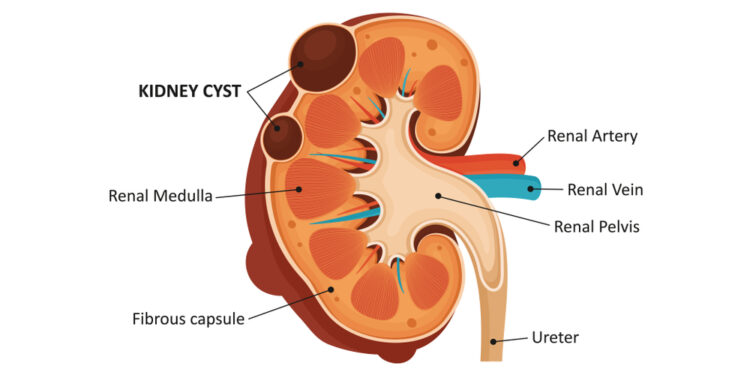 Medulinė kempinė inkstuose: priežastys, simptomai ir gydymas